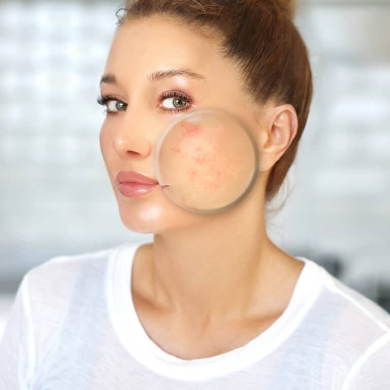 acne scar removal calgary