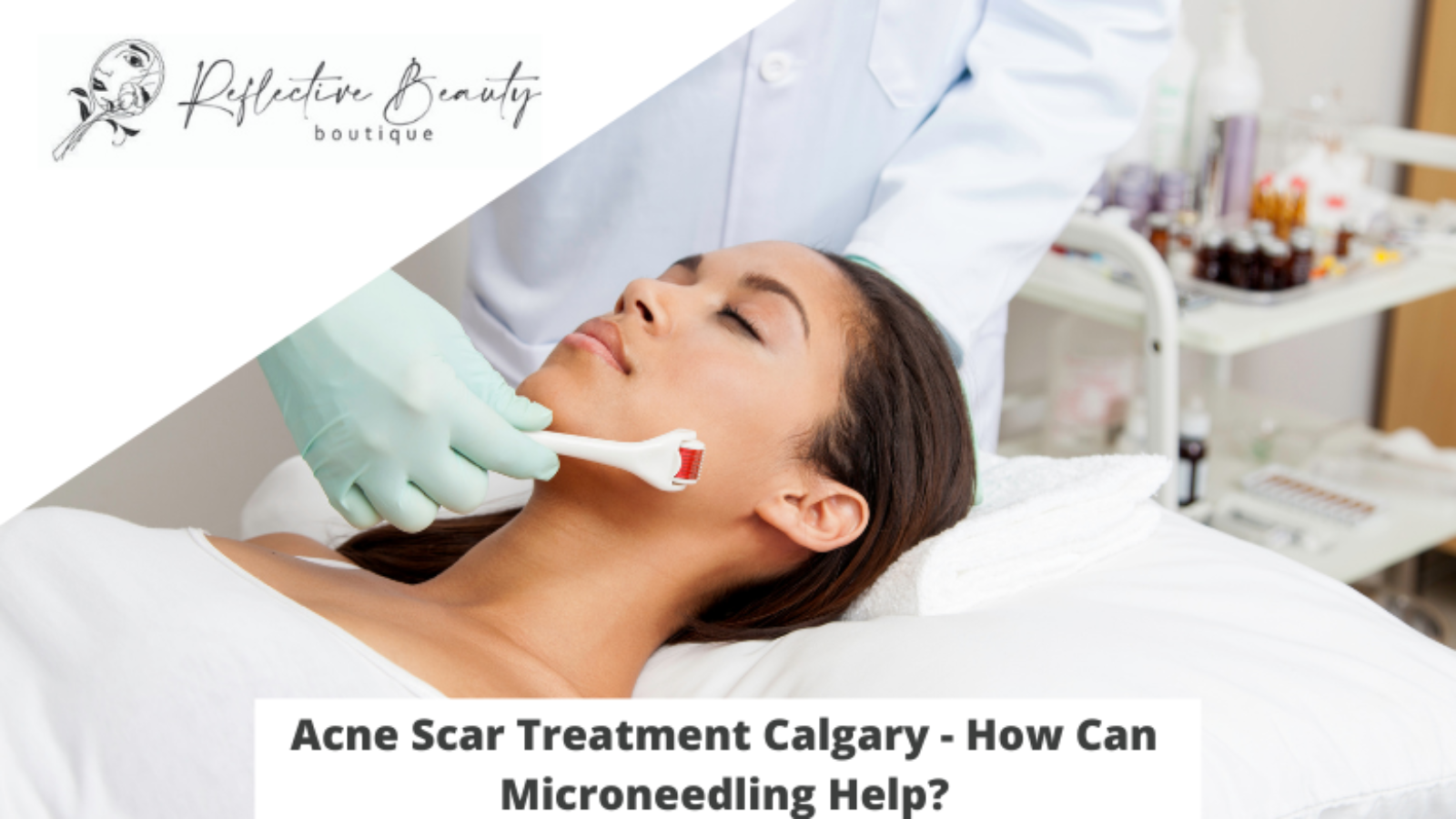 Acne Scar Treatment Calgary - How Can Microneedling Help