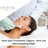 Acne Scar Treatment Calgary - How Can Microneedling Help
