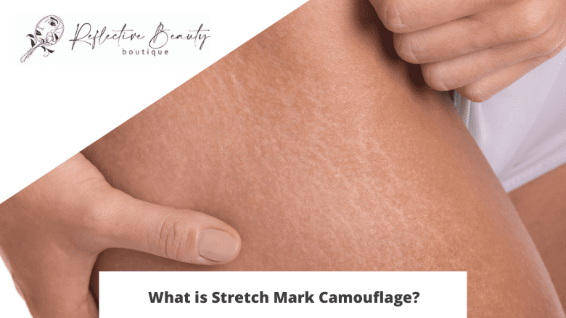 What is stretch mark camouflage