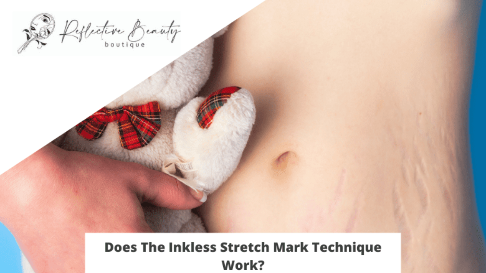 Does The Inkless Stretch Mark Technique Work