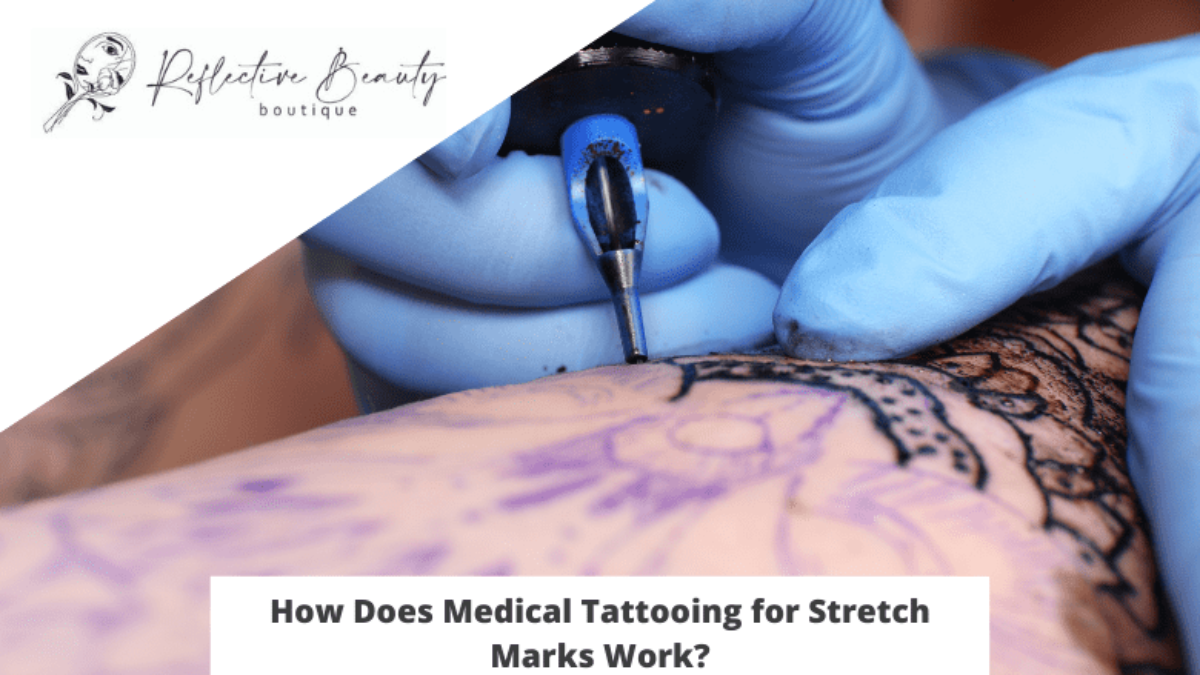 How Does Medical Tattooing for Stretch Marks Work