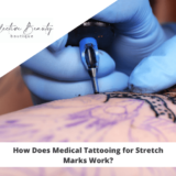 How Does Medical Tattooing for Stretch Marks Work