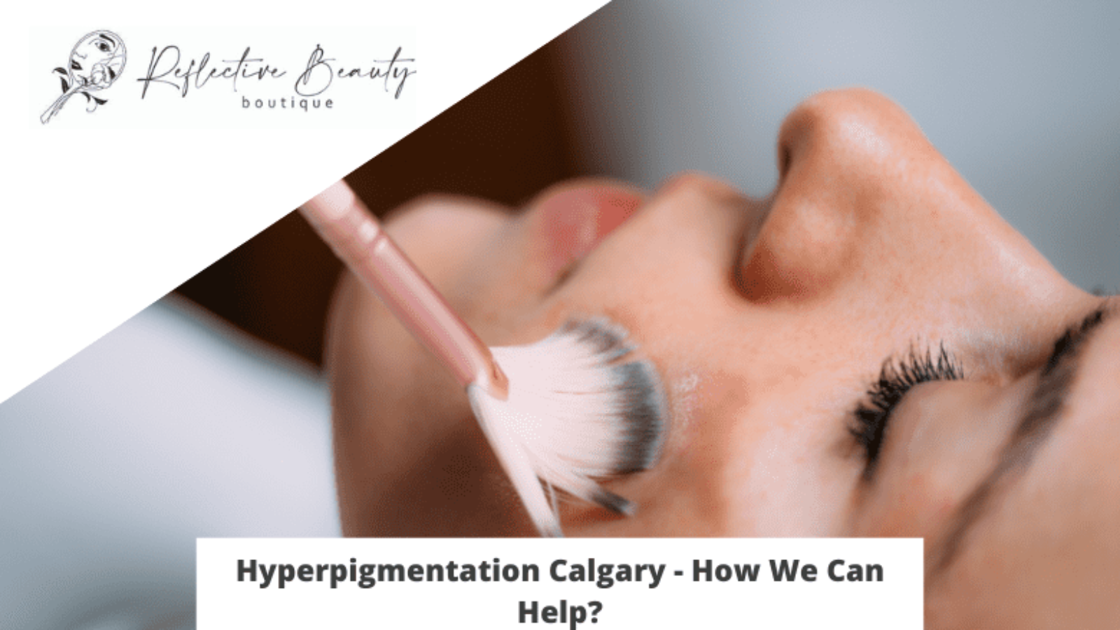 Hyperpigmentation Calgary - How We