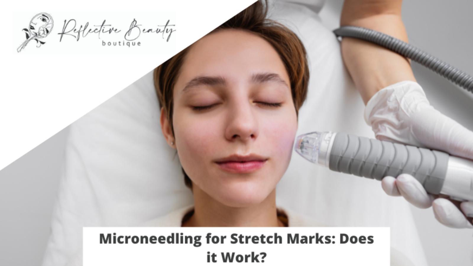 Microneedling for Stretch Marks Does it Work