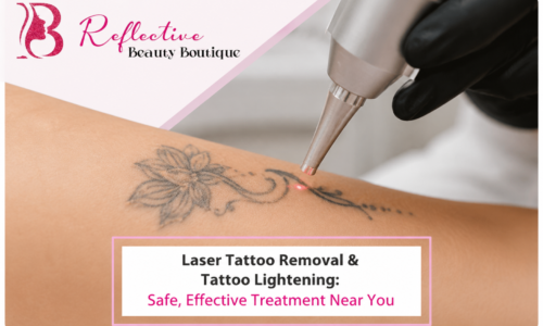 Laser Tattoo Removal & Tattoo Lightening