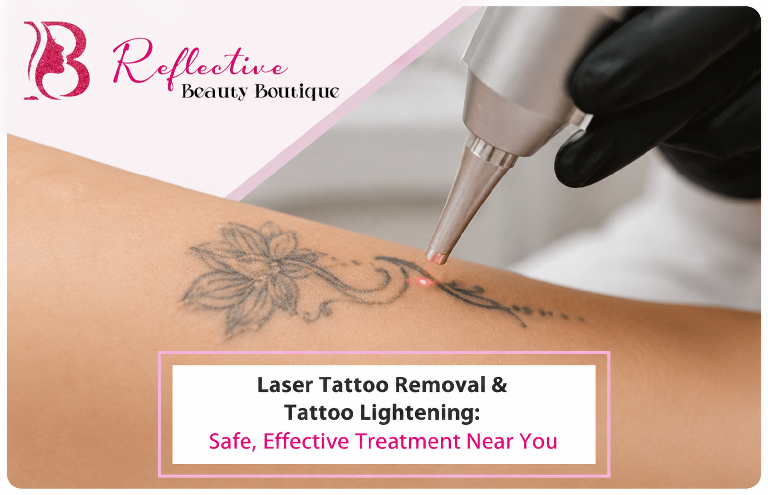 Laser Tattoo Removal & Tattoo Lightening